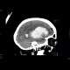 Intracerebral hemorhage, hemocephalus, artifact from malfunctioning detector: CT - Computed tomography