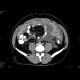 Carcinosis of mesentery: CT - Computed tomography