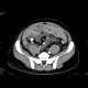 Carcinosis of mesentery: CT - Computed tomography