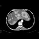 Carcinoid metastatses in the liver: CT - Computed tomography