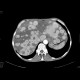 Carcinoid metastatses in the liver: CT - Computed tomography