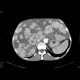 Carcinoid metastatses in the liver: CT - Computed tomography