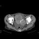 Carcinoid metastatses in the liver: CT - Computed tomography