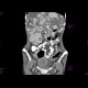 Carcinoid metastatses in the liver: CT - Computed tomography