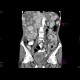 Carcinoid metastatses in the liver: CT - Computed tomography