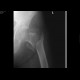 Pertrochanteric fracture, comminuted: X-ray - Plain radiograph