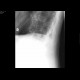 Compression fracture, first lumbar vertebra, osteoporosis: X-ray - Plain radiograph