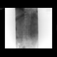 Compression fracture, second lumbar vertebra: X-ray - Plain radiograph