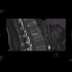 Compression fracture, second lumbar vertebra: CT - Computed tomography