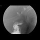 Extramural compresson of sigmoid colon: RF - Fluoroscopy