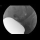 Extramural compresson of sigmoid colon: RF - Fluoroscopy