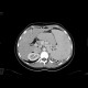 Congenital liver fibrosis, portal hypertension, porto-venous shunts: CT - Computed tomography
