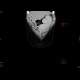 Congenital liver fibrosis, portal hypertension, porto-venous shunts: CT - Computed tomography