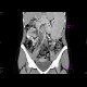 Congenital liver fibrosis, portal hypertension, porto-venous shunts: CT - Computed tomography