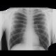 Clip in the lung parenchyma after resection of bulla: X-ray - Plain radiograph