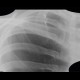 Clip in the lung parenchyma after resection of bulla: X-ray - Plain radiograph