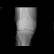 Bone infact: X-ray - Plain radiograph