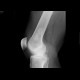 Bone infact: X-ray - Plain radiograph