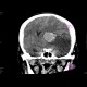 Intraparenchymal hemorrhage: CT - Computed tomography