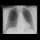 Lobus venae azygos, azygous lobe: X-ray - Plain radiograph