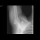Acromioclavicular dislocation: X-ray - Plain radiograph