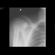 Acromioclavicular dislocation: X-ray - Plain radiograph