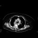 Lymphoma encroaching spinal canal: CT - Computed tomography