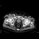 Lymphocoele: CT - Computed tomography