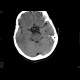 Adenoma of hypophysis, before and after resection: CT - Computed tomography