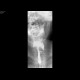 Massive aspiration, laryngeal dysphagia, tracheostomy: RF - Fluoroscopy