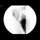 Massive aspiration, laryngeal dysphagia, tracheostomy: RF - Fluoroscopy