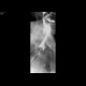Massive aspiration, laryngeal dysphagia, tracheostomy: RF - Fluoroscopy
