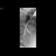 Massive aspiration, laryngeal dysphagia, tracheostomy: RF - Fluoroscopy