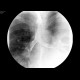 Massive aspiration, laryngeal dysphagia, tracheostomy: RF - Fluoroscopy