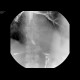 Massive aspiration, laryngeal dysphagia, tracheostomy: RF - Fluoroscopy
