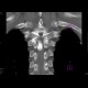 Meningioma of the spinal canal: CT - Computed tomography