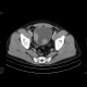 Bladder carcinoma, bone metastasis: CT - Computed tomography