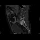 Spondylolisthesis, isthmic spondylolysis: CT - Computed tomography
