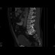Spondylolisthesis, isthmic spondylolysis: CT - Computed tomography