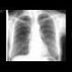 Lung metastases: X-ray - Plain radiograph