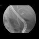 Gallbladder stones, multiple, cholecystolithiasis: RF - Fluoroscopy