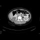 Renal cell carcinoma, multilocular and cystic: CT - Computed tomography