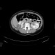 Renal cell carcinoma, multilocular and cystic: CT - Computed tomography