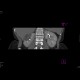 Renal cell carcinoma, multilocular and cystic: CT - Computed tomography