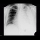 Myeloma of thorax wall: X-ray - Plain radiograph
