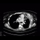 Myeloma of thorax wall: CT - Computed tomography