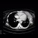 Myeloma of thorax wall: CT - Computed tomography