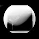 Rectal intususception, second degree, defecography: RF - Fluoroscopy
