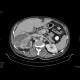 Renal cell carcinoma, thrombosis of the inferior vena cava: CT - Computed tomography