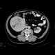 Renal cell carcinoma: CT - Computed tomography